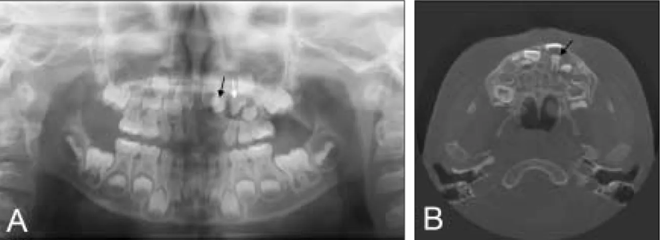 Fig. 4. 3 months after marsupialization, xray (A: Panoramic view, B: CT view) showed decrease of cystic space and also bony healing of the space