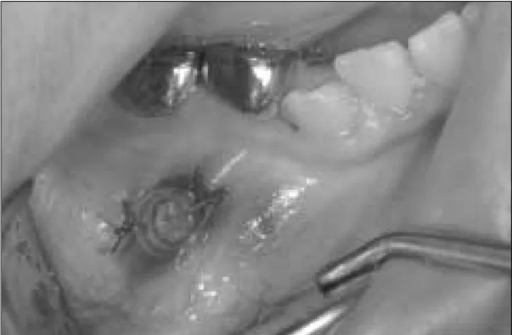 Fig. 8. Chemoport catheter was cut and modified to use as a patency path- path-way of the marsupialized cavity