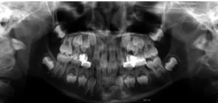 Fig.  4. CBCT  image.  Ankylosis  was  suspected  at  distal  root  of  the mandibular left first molar.