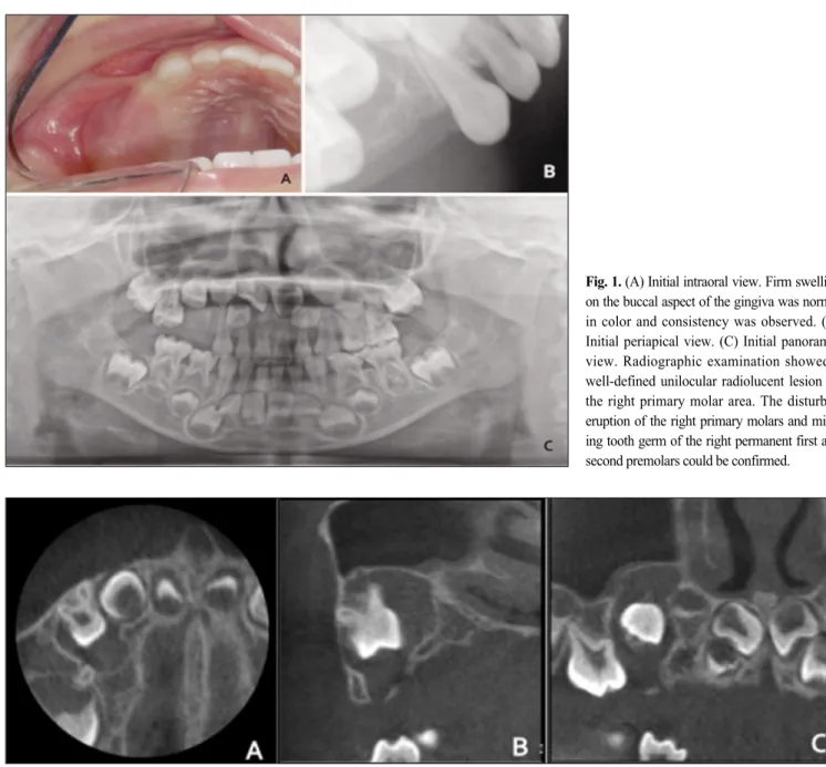 Fig. 1. (A) Initial intraoral view. Firm swelling on the buccal aspect of the gingiva was normal in  color  and  consistency  was  observed