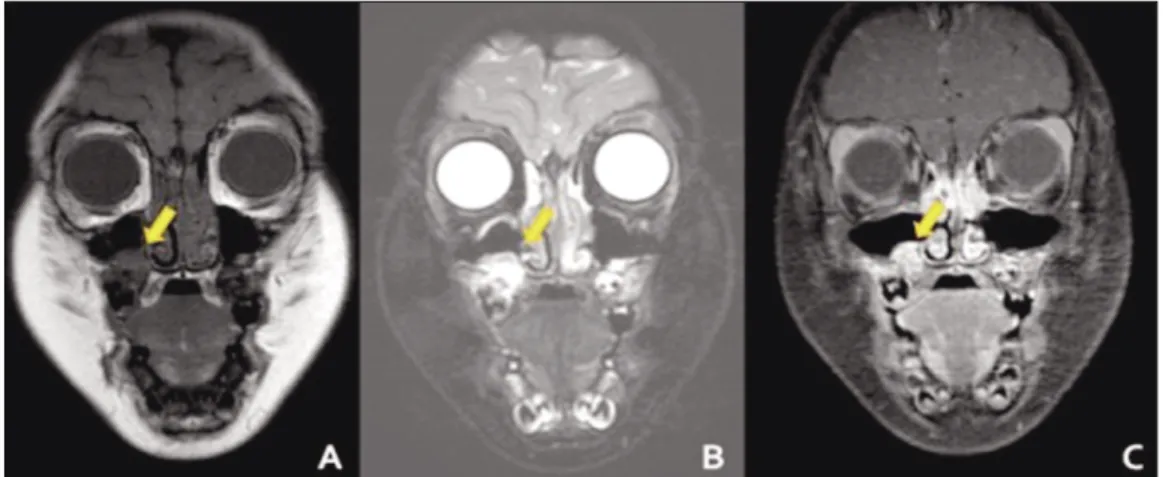 Fig. 3. (A) In the T1-weighted images, a low signal appeared in the area consistent with the CT image
