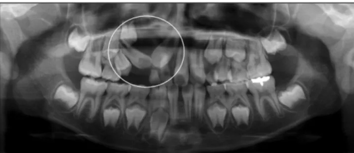 Fig.  1. Initial  panoramic  view.  Expansive  lesion  at  the  right  anterior maxilla deviated of #11,12 laterally