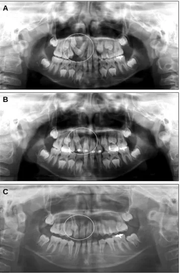 Fig. 5. Panoramic view after (A) 3 months, (B) 8 months, (C) 27 months, respectively. Bony healing was observed on upper right central and lateral incisior.