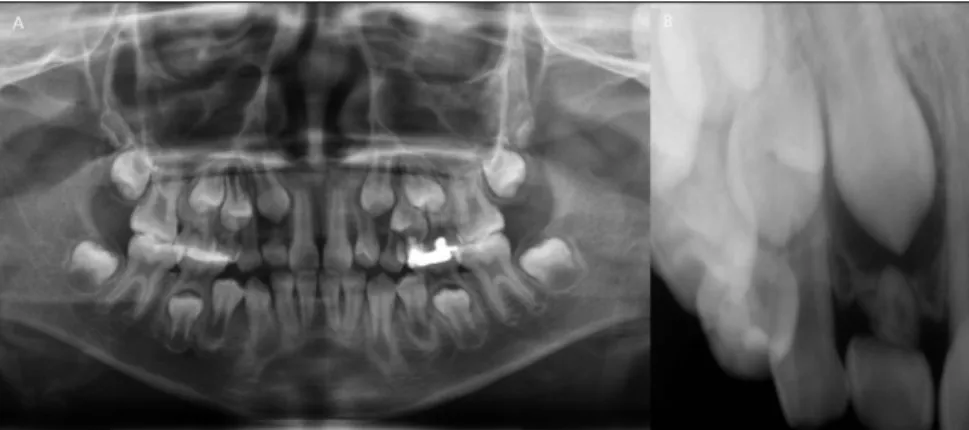 Fig. 5. Four months later, the cusp tip of canine was appeared in the position of cen- cen-tral incisor