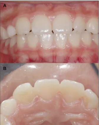 Fig. 8. 5-year later, intraoral and radiologic examinations showed no pathologic changes