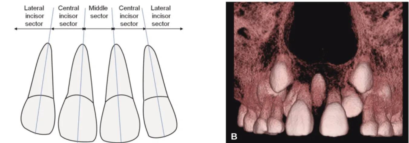 Fig. 1. Definition of sectors in frontal plane. A: Middle sector represents area between the long axis of two central incisors; central incisor sector represents the area between the long axis of central and lateral incisors; lateral incisor sector represe