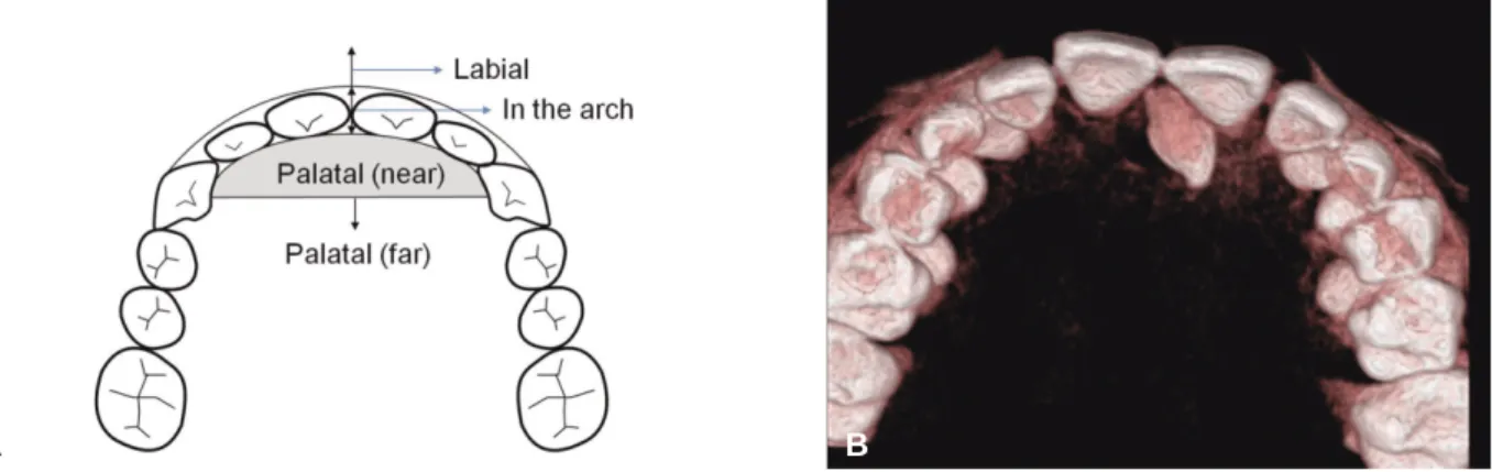 Fig. 4. Distribution of mesiodens according to the age.