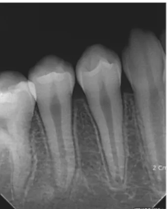 Fig. 1. Periapical radiograph at initial examination.