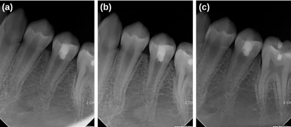 Fig. 11. (a) 2 months, (b) 9 months, (c) 13 months after PRF and MTA were applied. The root wall thickening and root lengthening have occurred.