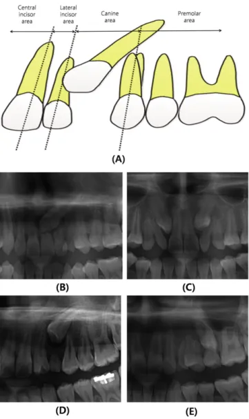 Fig.  3. The  vertical  position  of  cuspal  tip  of  an  impacted  canine  in  the sagittal  plane