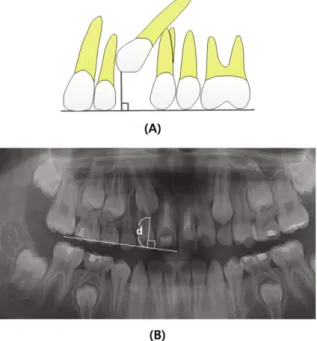 Fig.  4. Distance  (d)  from  the  tip  of  the  impacted  canine  to  the  occlusal plane
