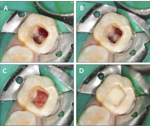 Fig. 2. (A) Characteristics of blood samples after centrifugation. A fibrin clot in the middle of the tube (PRF) between the red blood corpuscles at the bottom and acellular plasma at the top of the tube