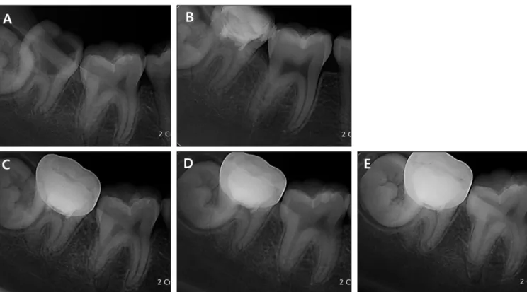 Fig. 4. Periapical view of the case 2. (A) Preoperative radiograph showing a deep caries of the right mandibular second molar