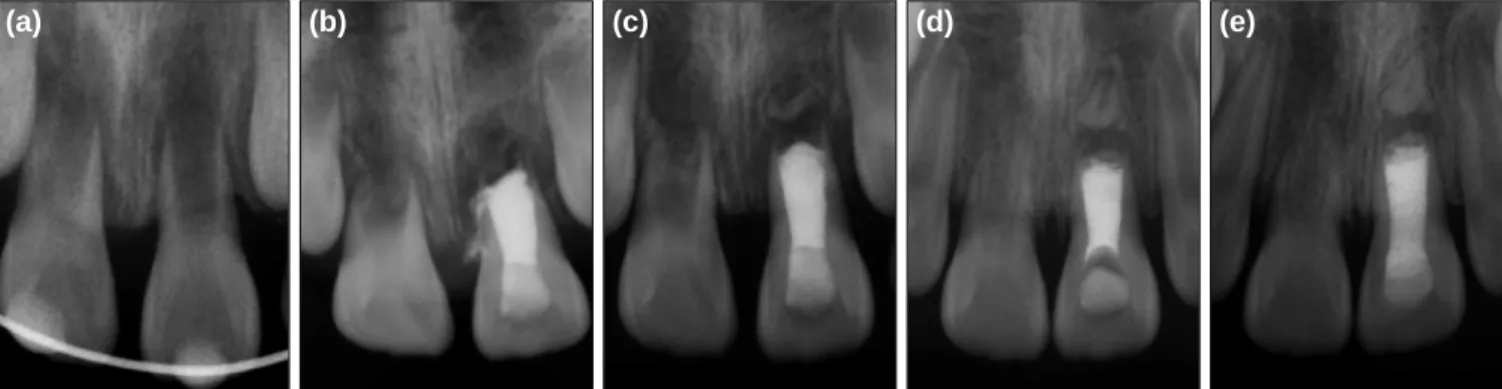 Fig. 1. Periapical  views. (a) Initial visit; replanted maxillary central incisors with open apexes were observed