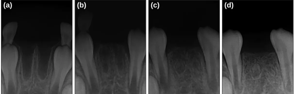 Fig. 2. Periapical  views. (a) Initial visit; sockets of the completely avulsed mandibular central incisors were observed
