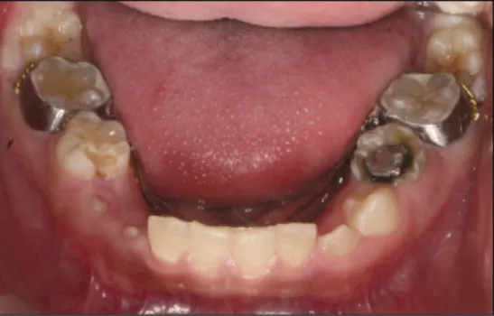 Fig. 3. 3 months after brass wire insertion. Fig. 4. 7 months after treatment.