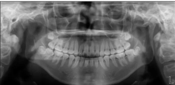 Fig. 13. 4 weeks after uprighting. Fig. 14. Leveling and aligning of second molar.  Fig