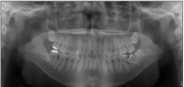 Fig. 16. Pre-treatment clinical view. Fig. 17. Pre-treatment panoramic view.