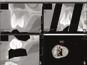 Fig.  1. CBCT  measurement.  The  unerupted  teeth  of  the  3D  image  was reoriented  to  parallel  to  the  axis  of  the  teeth