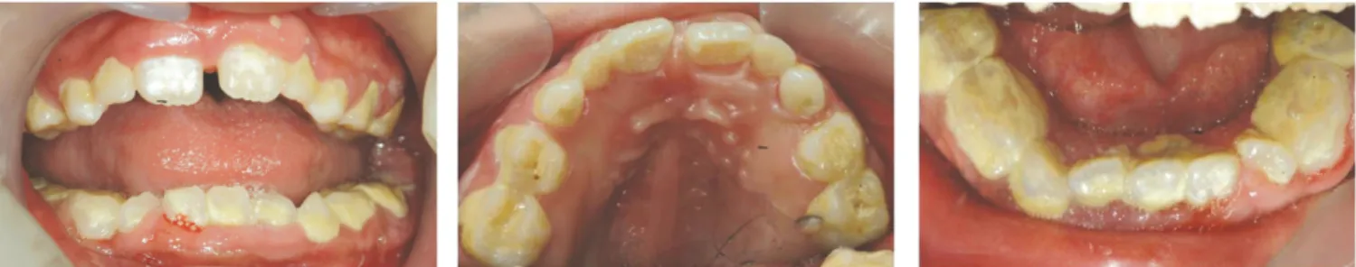 Fig. 3. Standard X-rays show loss of lamina dura and delayed eruption of permanent teeth.