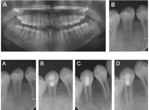 Fig.  1. Initial  radiograph  of  case  1.  (A)  Panoramic view,  (B)  Periapical  view