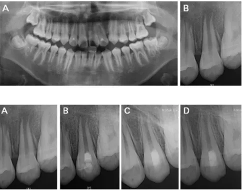Fig. 6. Periapical view of case 3. (A) Initial visit, (B) After  1  month,  (C)  After  4  month,  (D)  After  6 month