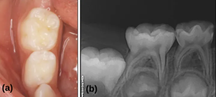 Fig. 1. Intraoral view(a) and Periapical view(b) at first visit. 