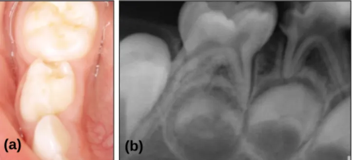 Fig. 9. Intraoral view(a) and Periapical view(b) at first visit.