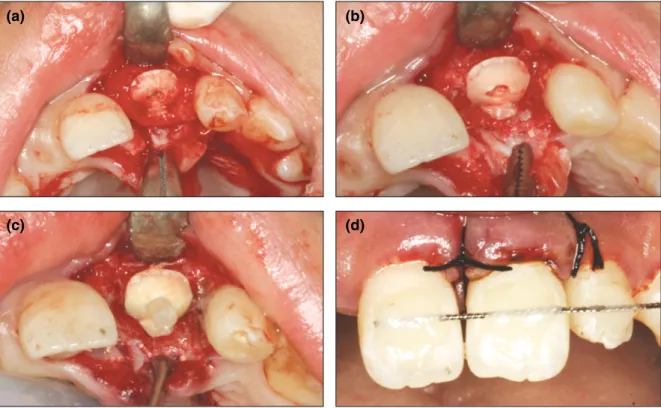 Fig.  1. Radiographs  at  first  visit.  (a)  Before  removing  the  crown  frag- frag-ments