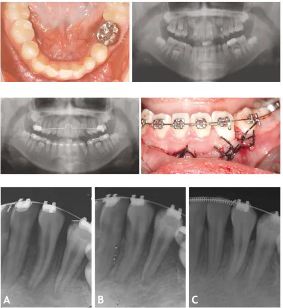 Fig.  1. Initial  intraoral  and  panoramic view.  The  lower  left  canine  showed horizontal position in the anterior  sex-tant and incomplete root formation.
