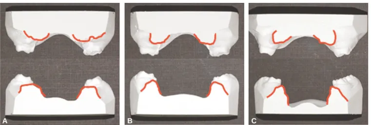 Fig. 5. The change of the alveolar rigdes height of edentulous area. The decrease of vertical bony defect was observed
