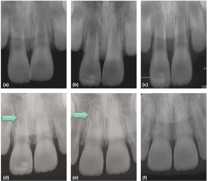 Fig. 1. Periapical views (a) initial, apical PDL widening of upper right central incisor was seen
