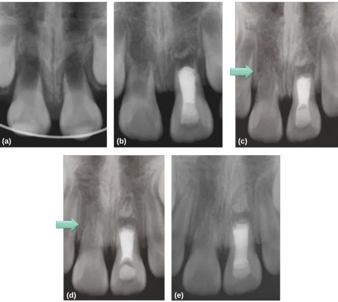 Fig. 2. Periapical views (a) short root length and wide open apex of upper central incisors were seen