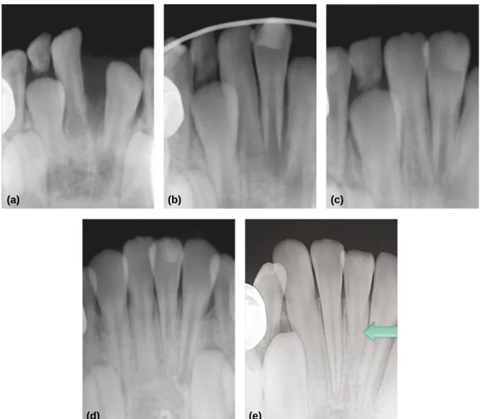 Fig. 3. Periapical views (a) initial, totally avulsion of lower left central incisor was seen
