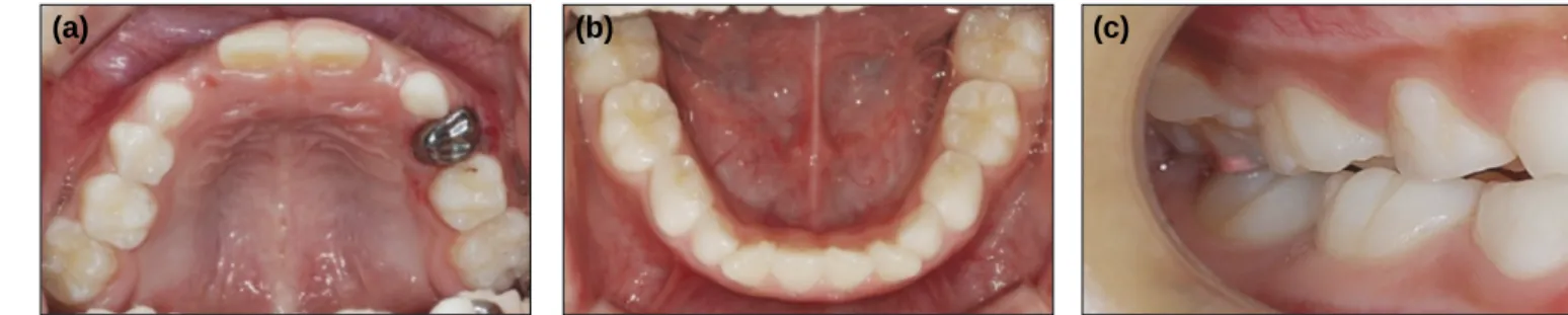 Fig. 2. Criss-cross elastic with bite raising.  Fig. 3. Sectional TMA wire insertion.