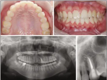 Fig. 3. a) After 7 months, there was no root resorption of the canine, but apical lesion was detected