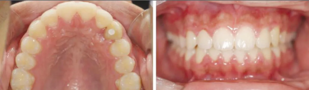 Fig. 9. Posttreatment follow up of 2 years after autotransplantation. The radiographs showed that the canine was retained well without any periapical pathologic changes.