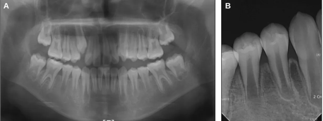 Fig. 1. Initial radiograph. (A) Panoramic radiograph and (B) Periapical radiograph at the first visit