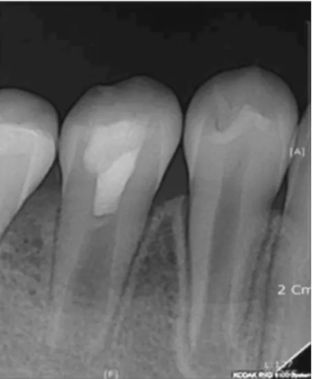 Fig. 4. Periapical radiography after 7 months. It is observed the formation of root development.