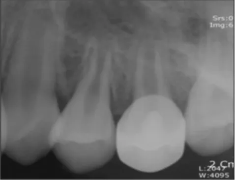 Fig. 10. Panorama radiography (A) and Periapical radiography (B) after 5 years. It is observed the completion of root development.