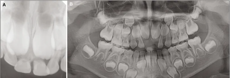 Fig. 1. A: Periapical view on first visit at 6-year 5-month-old. B: Panoramic view on the day after first visit.