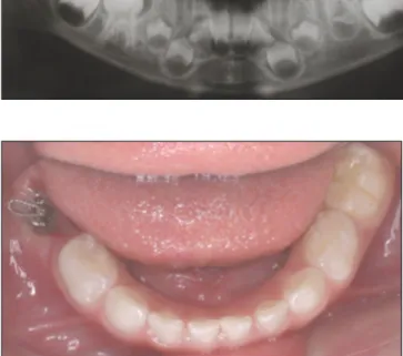 Fig.  3. After  surgical  removal  of  gingiva  on  the  occlusal  surface,  a  lin- lin-gual-button was attached on it.
