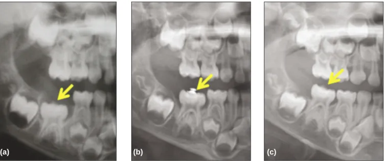Fig. 5. (a) First visit; mandibular right second primary molar was impacted. (b) 3 months after orthodontic traction, the tooth moved upward in response to orthodontic force