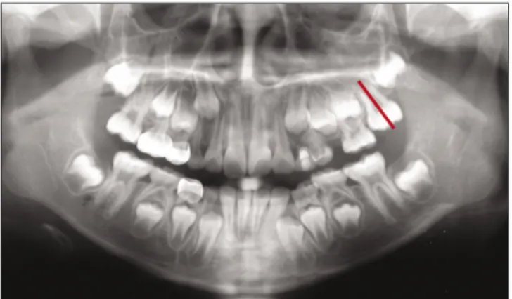 Fig. 2. Panoramic radiograph 12 months after extraction of E1. Fig. 5. Panoramic radiograph 58 months after extraction of E1.