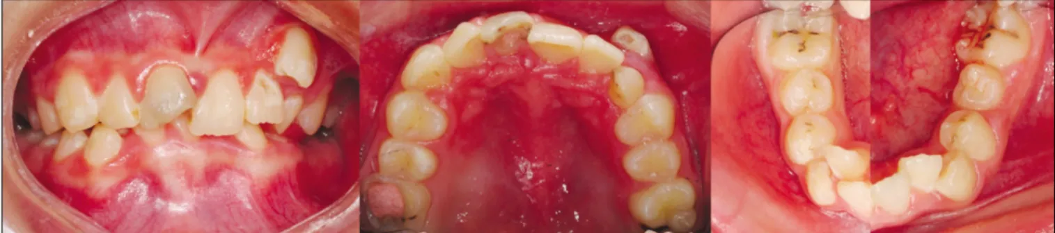 Fig. 6. Initial intraoral photograph at the age of 11 year and 1 months.