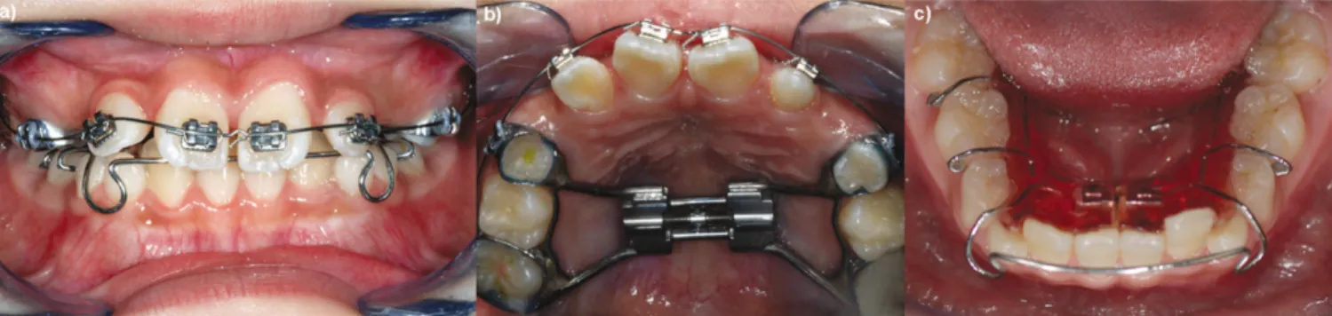 Fig. 6. After the four upper incisors were moved mesially, the eruption path of the upper right canine was corrected