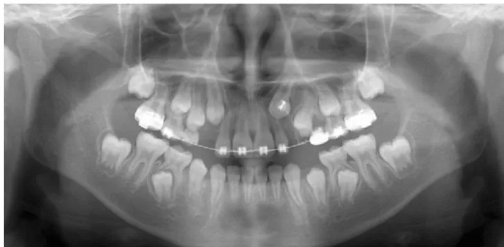 Fig. 12. The upper left maxillary canine was erupted by orthodontic forced eruption, and the upper right maxillary canine is expected to be erupted normally.