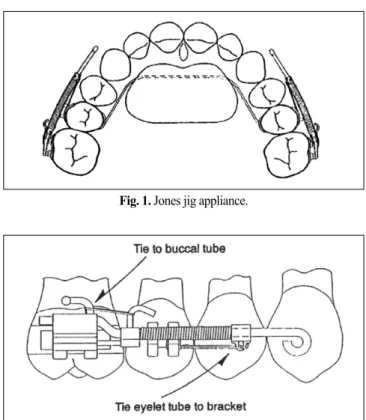 Fig. 1. Jones jig appliance.