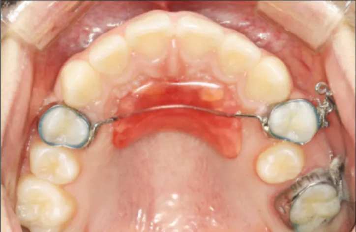 Fig. 5. Occlusal view at 5 months after Jones jig appliance activation and 1 month after elastic insertion