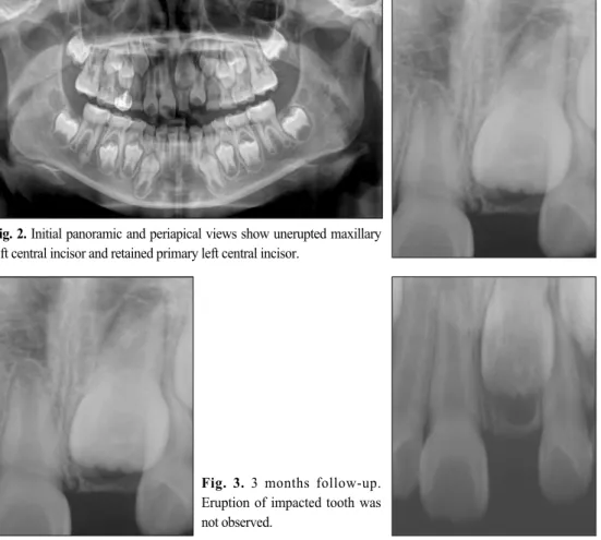 Fig. 2. Initial panoramic and periapical views show unerupted maxillary left central incisor and retained primary left central incisor.